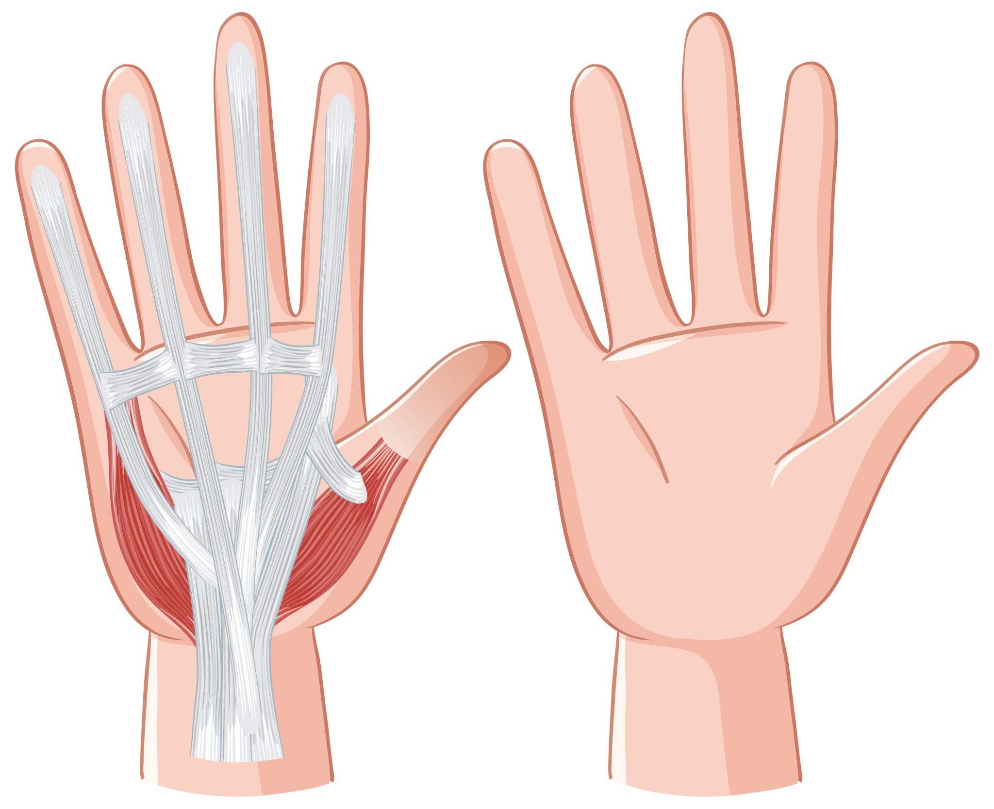 Tendinosis MANO