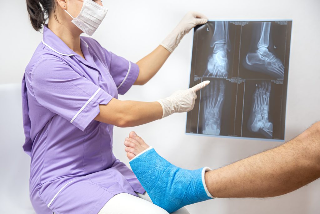 imagen fractura
