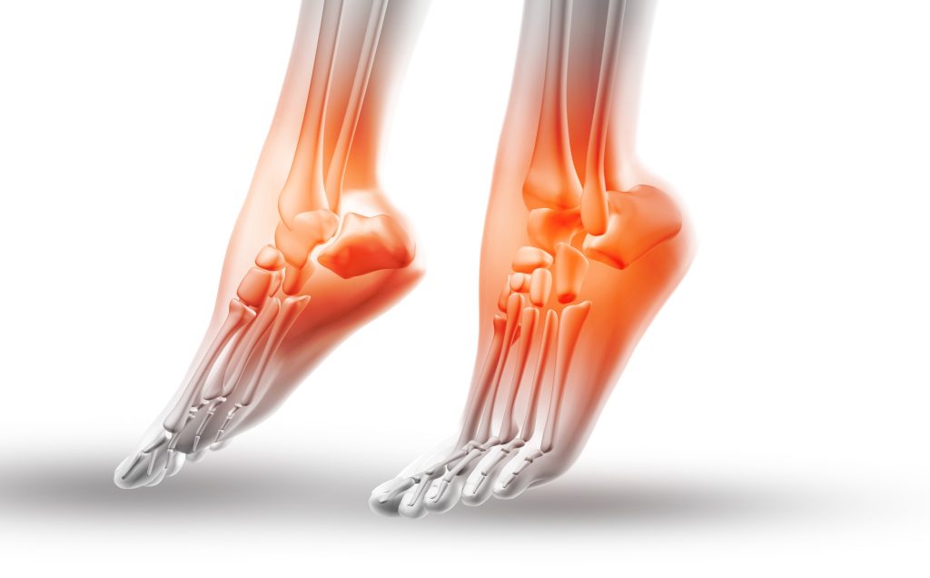 Tendinosis PIE